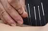 Kas Spazmına “Akupunktur“ İğneli Tedavi